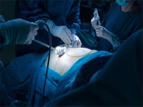 COVID-19 Impact on Minimally Invasive Gastrointestinal Surgical Systems in Healthcare Industry