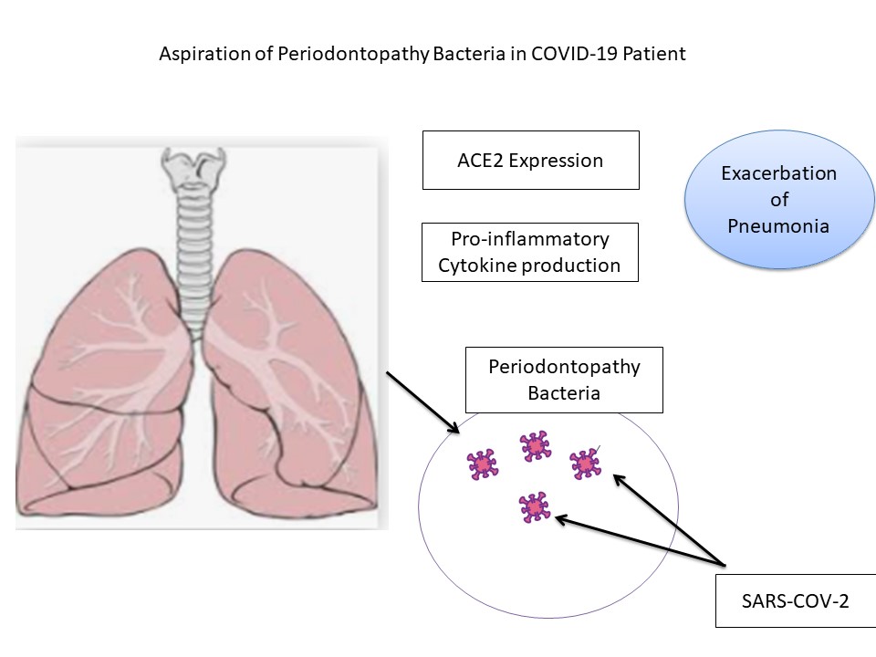 Aspiration of Periodontopathy Bacteria in COVID-19 Patient
